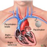 pacemaker